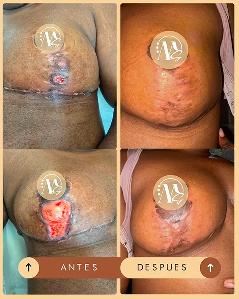 Img-Medical_Skin_Derma-Antes&Despues-2026-Cicatriz_seno-1