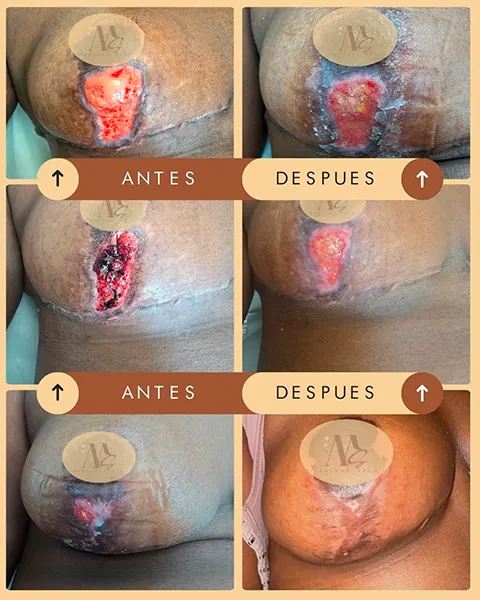 Img-Medical_Skin_Derma-Antes&Despues-2026-Cicatriz_seno-2