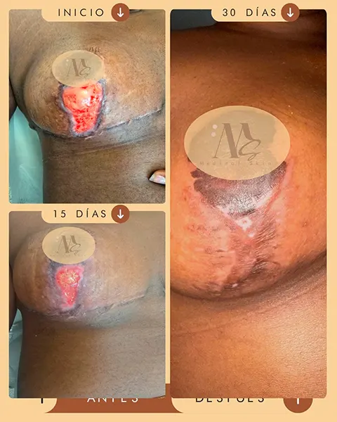 Img-Medical_Skin_Derma-Antes&Despues-2026-Cicatriz_seno-3