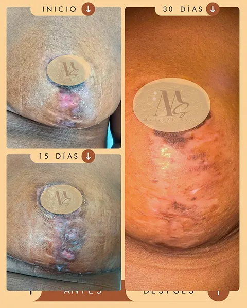 Img-Medical_Skin_Derma-Antes&Despues-2026-Cicatriz_seno-4