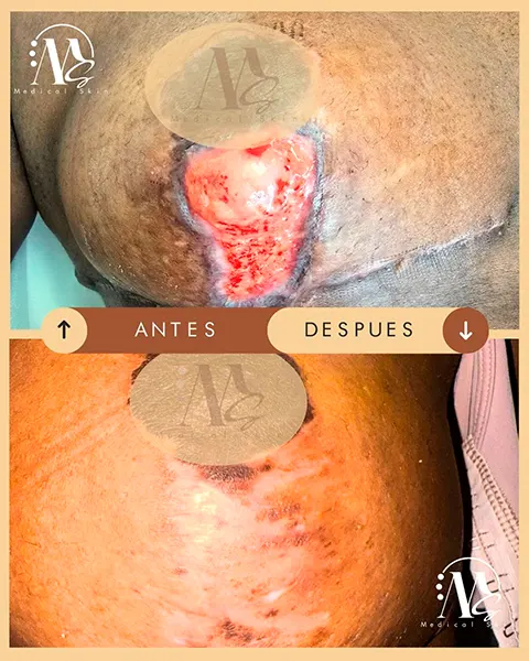 Img-Medical_Skin_Derma-Antes&Despues-2026-Cicatriz_seno-5