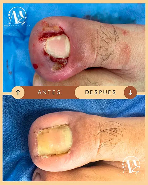 Img-Medical_Skin_Derma-Antes&Despues-2026-Uñas-1